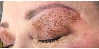 بلفاروپلاستی(افتادگی پلک) با لیزر بلفاروپلاستی(افتادگی پلک) با لیزر