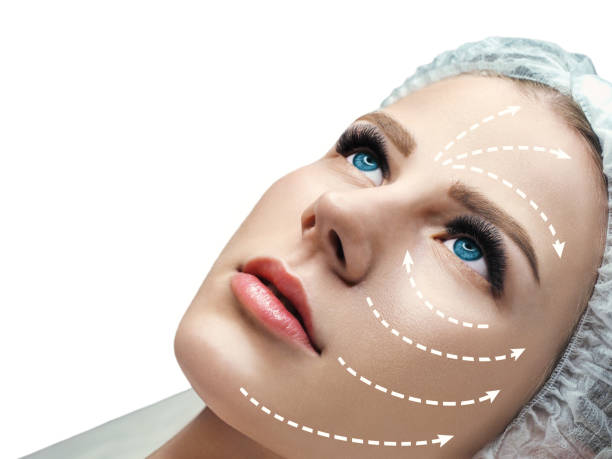 لیفت صورت و بدن با نخ آپتوس لیفت صورت و بدن با نخ آپتوس